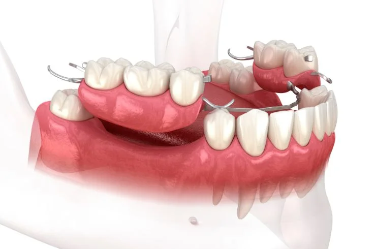 pawar dental Cast Partial