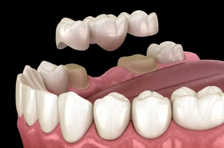 pawar dental Crown & Bridges