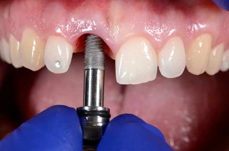 pawar dental Dental Implants